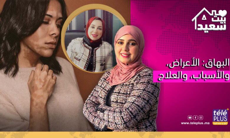 بيت سعيد | البهاق: الأعراض، والأسباب، والعلاج مع دكتورة هاجر أعماروش أخصائية أمراض الجلد